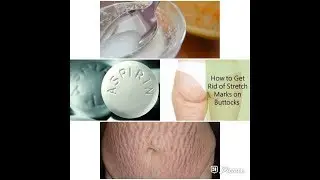 Use aspirin remove stretch marks in one week/ how to get rid of stretch marks very fast