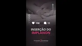 Como &eacute; feita a Inser&ccedil;&atilde;o do #IMPLANON | Dra. Fernanda Taumaturgo