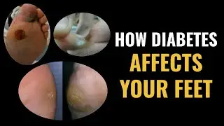 How Diabetes Affects Your Feet - Dr. Donald Pelto