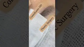 eyebrow hair transplant
