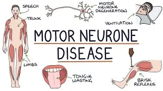 Motor Neuron Disease #motorneuronedisease #physiotherapy 