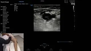 Tutorial Eco-Doppler Vascular - Mapeamento do Sistema Venoso Membros Inferiores