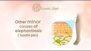 Minor Causes of Elephantiasis / filaria filariasis Haathi Pav ke anya Karan Dr neeraj pandey Raipur