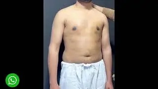 How to get rid from Gynecomastia | What is Gynecomastia - Male chest treatment - Dr Amin Yousaf