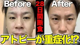 【28日間断食】アトピーが重症化!?【28日間ファスティングダイエット】