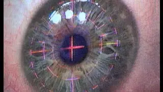 The Operation - Eye Witness Laser Eye Surgery Day 1a