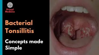 Bacterial Tonsillitis: Centor Criteria and FeverPAIN Score