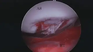 hemorrhagingtissue, офелия. - Sanguinis astra (Audio)