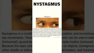 Nystagmus - Involuntary Eye Movement #nystagmus