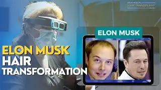 Celebrity Hair Transformations: Elon Musk | Nova Medical Hair Transplant Toronto