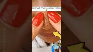 Remove Blackheads Whiteheads Naturally at home/ Blackheads Removal Pack 💯 #shorts #blackheadremoval