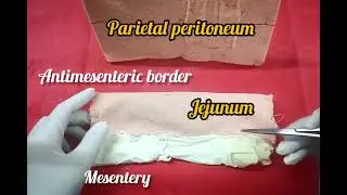 Модифицированная еюностомия Витцеля для кормления