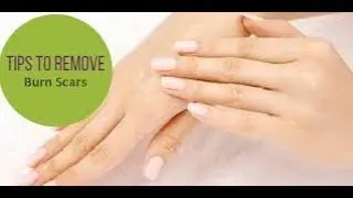 Easy and Simple Natural Home Remedies For Burns l  How to Remove Burns Naturally from Home !!!