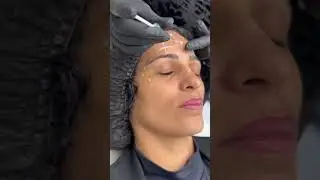 Como tratar rugas da testa | aplica&ccedil;&atilde;o de botox