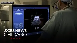 How UChicago Medicine can destroy liver tumors using only sound waves