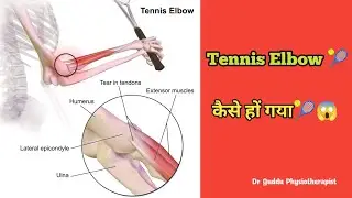 Tennis Elbow 🎾😱: (Lateral Epicondylitis), Definition,Causes,Symptoms,Diagnosis & Treatment Notes 