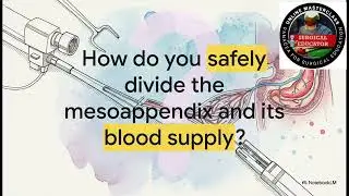 Laparoscopic Appendicectomy - AI collaborative simulated case scenario discussions
