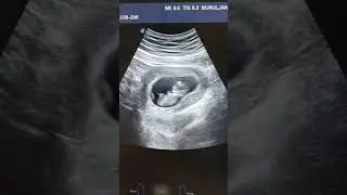 11 Weeks 3 Days Ultrasound : My Baby is Actively Kicking😍
