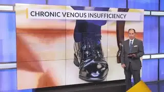 Trump's swollen ankles linked to vein condition