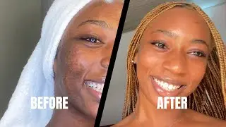 Skin care transformation: DOVE soap transformation in 2-3 weeks