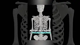 I have the spine of an 80 year old at 39. Epilepsy caused the damage. Link in bio. #i...