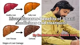Liver disease and Unani Treatment #liver #ayurvedic #fattyliver