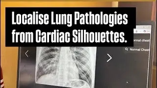 Localising Lung Pathologies from Cardiac Silhouettes.