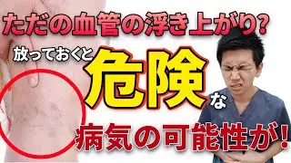 【放置厳禁】血行不良のサイン！細絡の原因と対策をお伝えします『偏頭痛・下肢静脈瘤・月経トラブル』