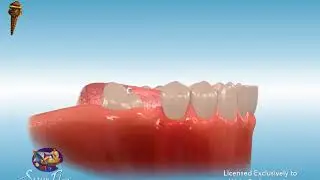 Uprighting Molars