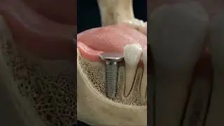 They Screw This Into Your BONE 🔩 Dental Implant Process