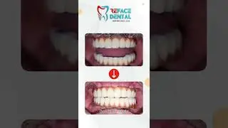 Fixed Teeth With Dental Implants | Reface Dental Meerut | Dr. Gaurav Dhaka