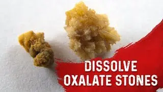 Why You Get Kidney Stones (Oxalate Type) &ndash; Removing Kidney Stones & High Oxalate Foods &ndash; Dr.Berg