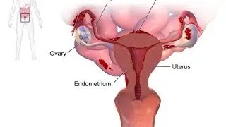 CLASS 8: ENDOMETRIOSIS PART3 FOGSI GUIDDLINES