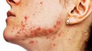 Chemick&yacute; peeling RedPEEL od Laboratoires Renophase