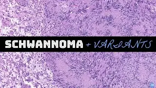Schwannoma & Variants | Spindle Cell Unknowns (Case #1) | #BSTPATH Cases for Residents