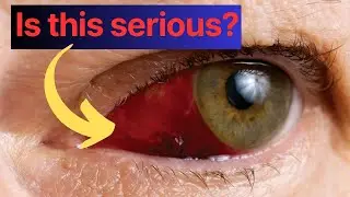 Проснулись с красным глазом? Что делать?