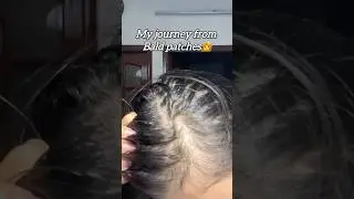 From Bald Patches to Fuller Scalp ✨ Start Your Hair Growth Journey with Me | Subscribe for More!