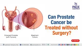 Can Prostate Cancer be Treated without Surgery? | #prostatecancer