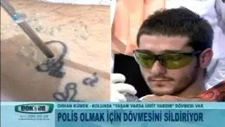 Vücuttaki dövmeler nasıl siliniyor?