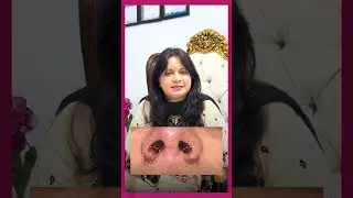 Kya Aesi Rhinoplasty Hai Jis Ka Koi Nishan Na Ho? - Is Scarless Rhinoplasty Really Possible?