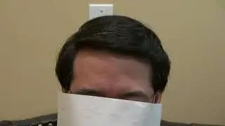 Hair Transplant Procedure for Asian Male by Bay Area Doctor