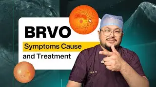 BRVO (पर्दे की नस फट जाना ) | लक्षण, कारण और इलाज | #retina #eyes #facts
