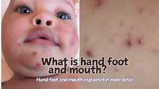 Hand, foot and mouth explained in a quick 30 second video