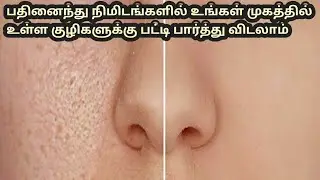 clean & clear skin best remedy for (OPEN PORES) peel off mask for oil skin using just 2 ingredients