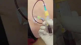 Colheita de sangue por FICC Port com agulha angulada Polyperf Safe, com Lock Sincronizado.