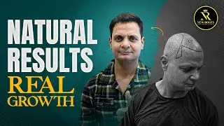 Achieving Natural Hair Density: 6000 Grafts MAGIC 😮 | New Roots Nagpur