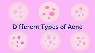 Everything You Need to Know About Acne: Causes, Types, Treatments, and Prevention