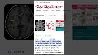 Moye Moye Disease। Moye Moye Syndrome ।#shorts #viral #pathology