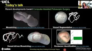 Invited talk: Mosaicking using Deep Learning in Fetoscopic Surgery