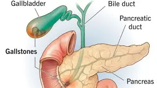 #Gall bladder #stone - laparoscopic #cholecystectomy is best treatment.Success story #cholecystitis
